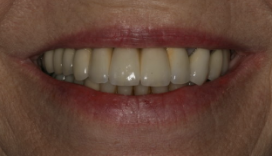 Missoula top teeth implants