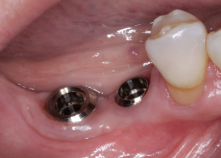Missoula dental implants