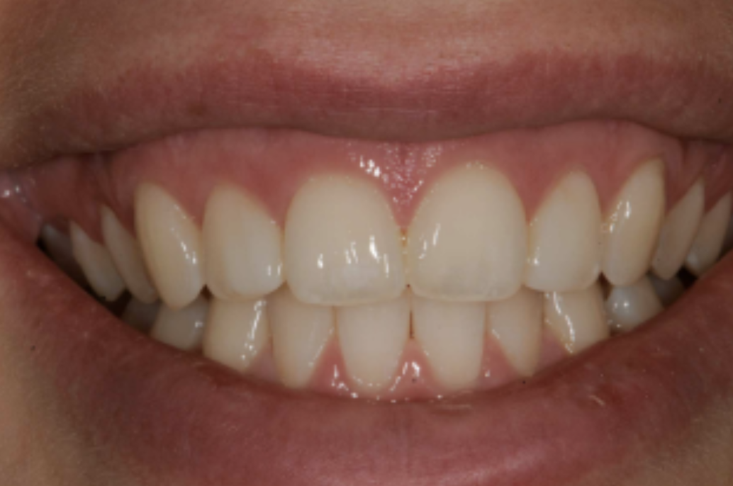 Missoula Dental Bonding