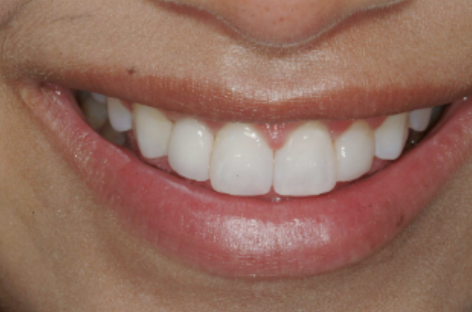 Missoula Teeth Whitening