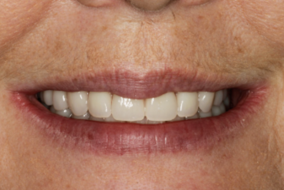 Missoula Implant Dentures
