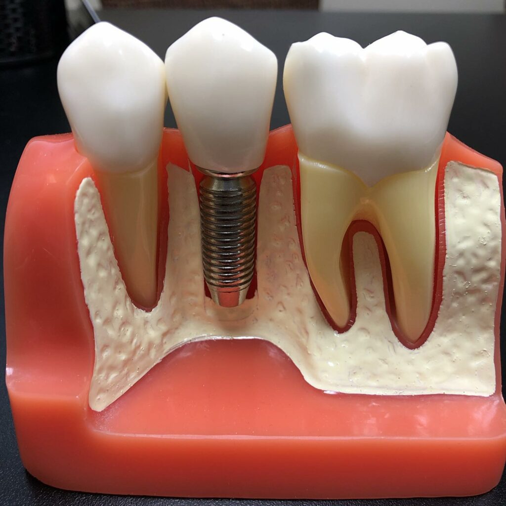 single dental implants implant meng dentistry missoula aging