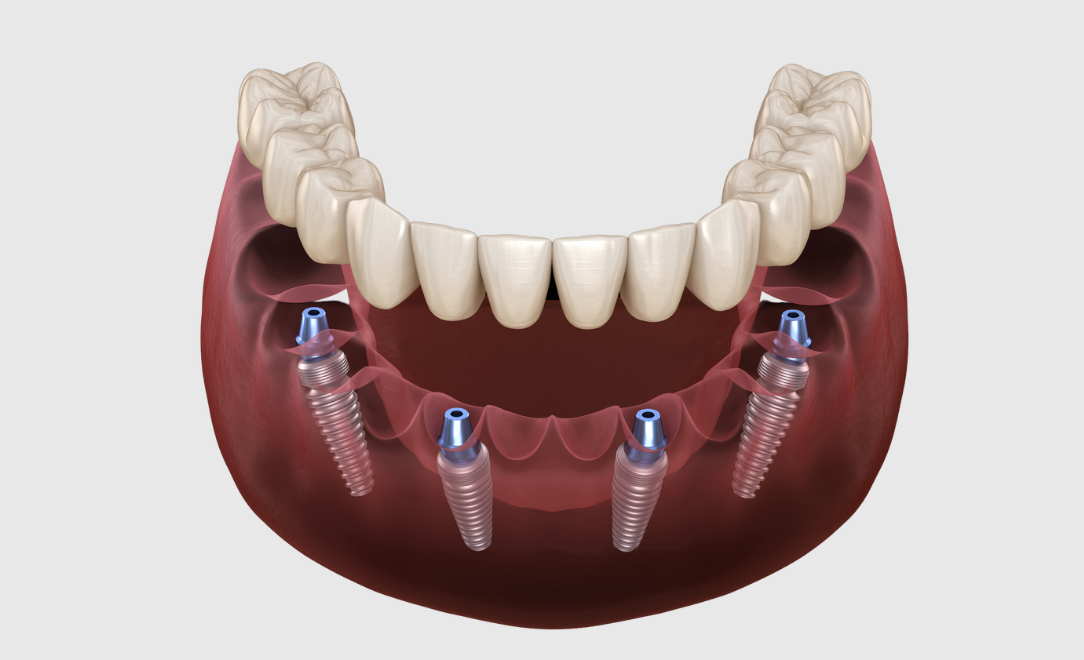 The Complete Guide To All On Four Dental Implants