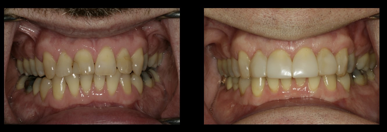 Anterior composite bonding