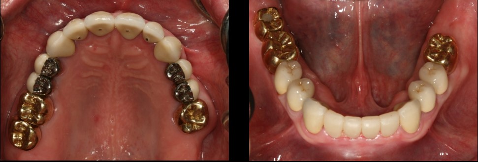 Full-Mouth Restoration After