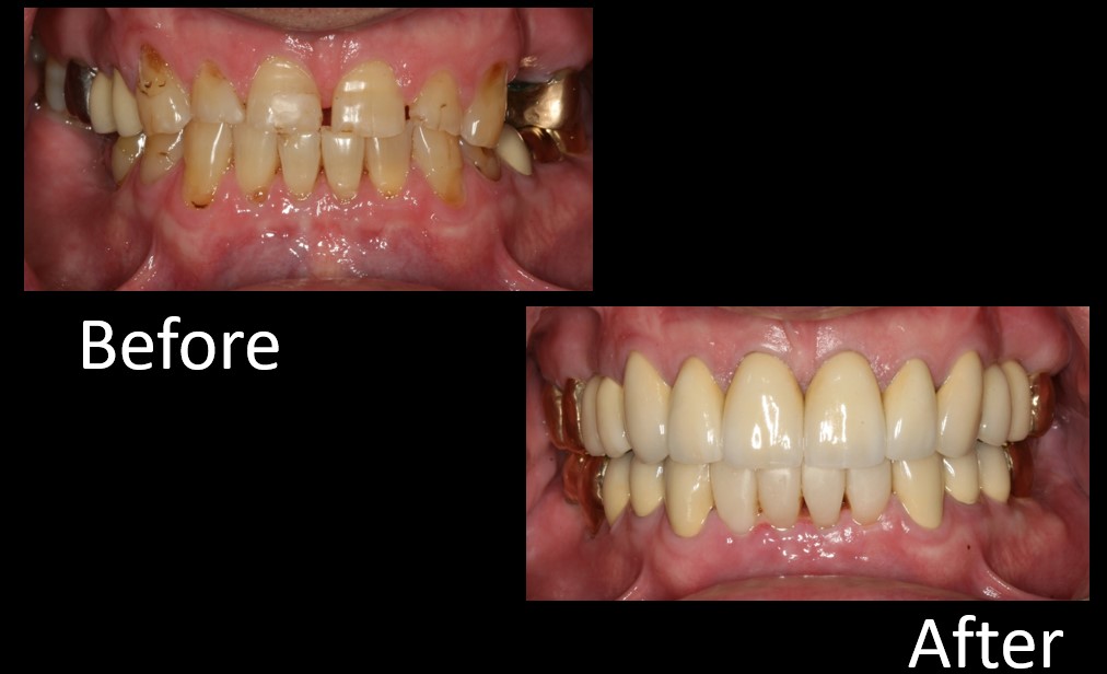 Full-Mouth Restoration