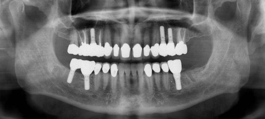 Full-Mouth Restoration Xrey