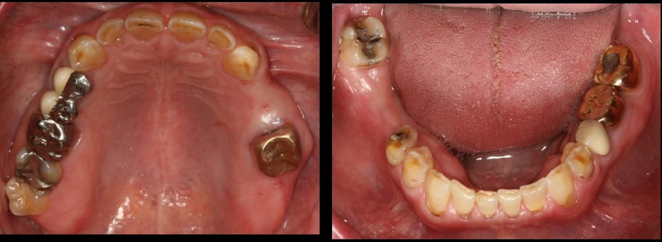 Full-Mouth Restoration Before