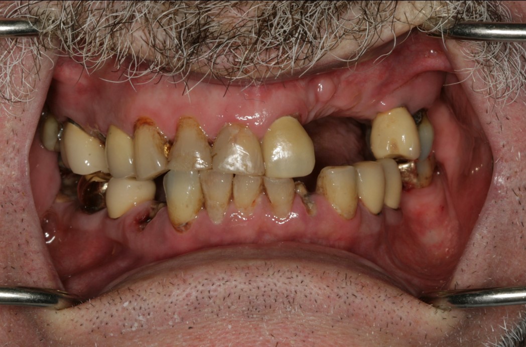 Dental Implant Before