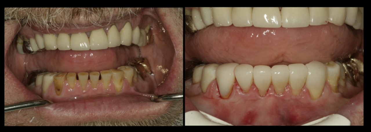 Lower Composite Bonding