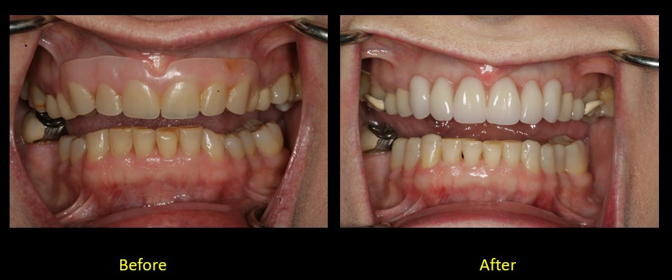 Porcelain Crowns