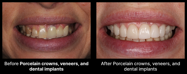 Porcelain Crown Before After