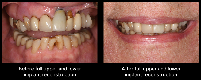 full upper and lower implant reconstruction