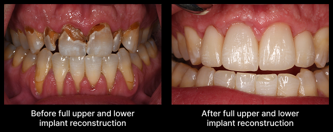 full upper and lower implant reconstruction
