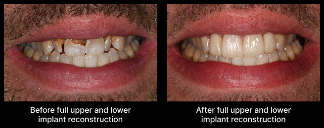 full upper and lower implant reconstruction