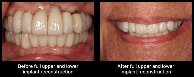 full upper and lower implant reconstruction