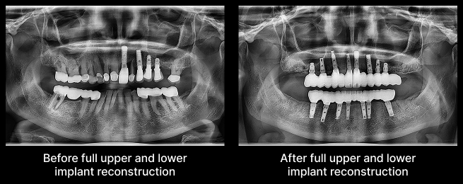 full upper and lower implant reconstruction