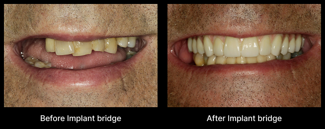 Dental Implant Before After