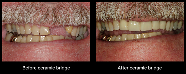 Dental Implant Before After