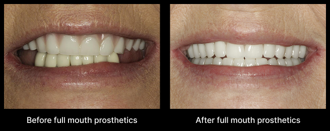 Dental Implant Before After