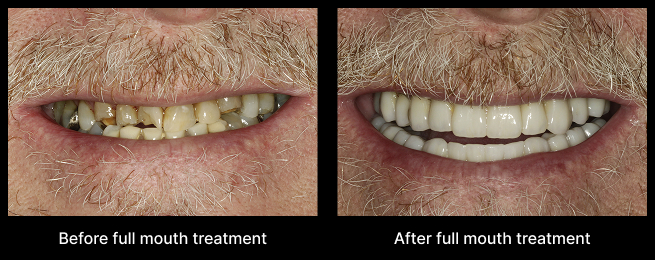 Dental Implant Before After