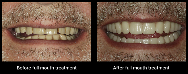 Dental Implant Before After