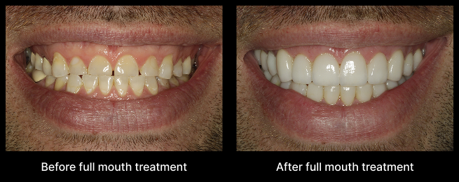 Dental Implant Before After