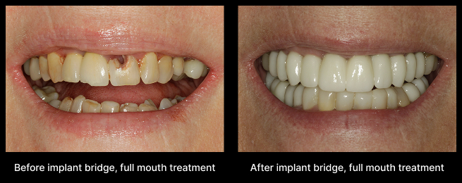 Dental Implant Before After