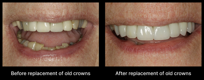 Dental Crowns Before After