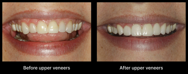 Upper Veneers Before After