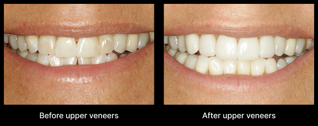 Upper Veneers Before After