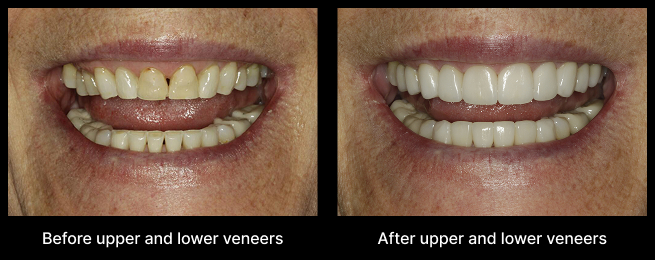 Upper Veneers Before After
