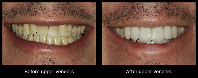 Upper Veneers Before After