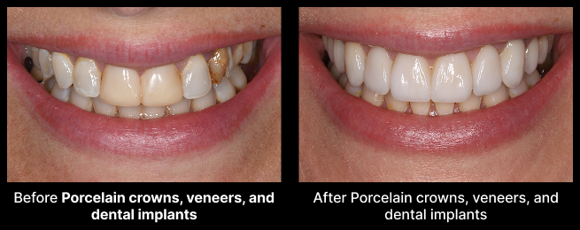 Porcelain Veneers Before After
