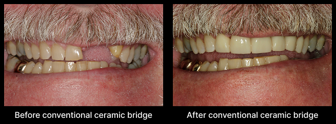 Ceramic Bridge Before After