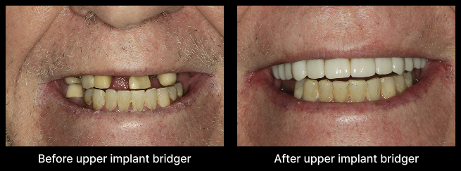 Dental Bridge Before After