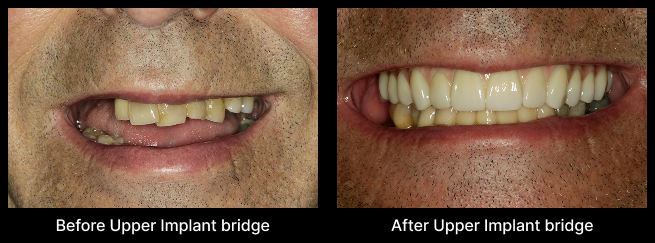 Dental Implant Before After
