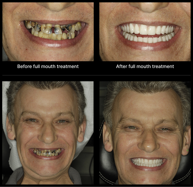 Dental Implant Before After