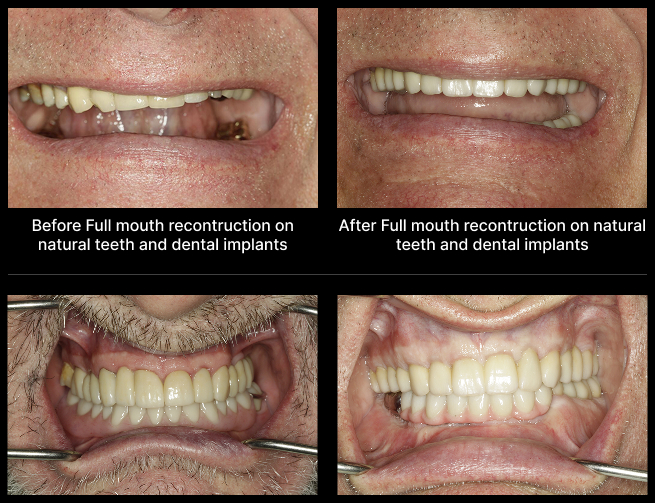 Dental Implant Before After