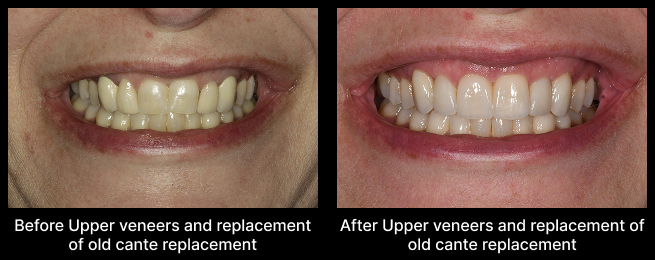 Veneers Before After