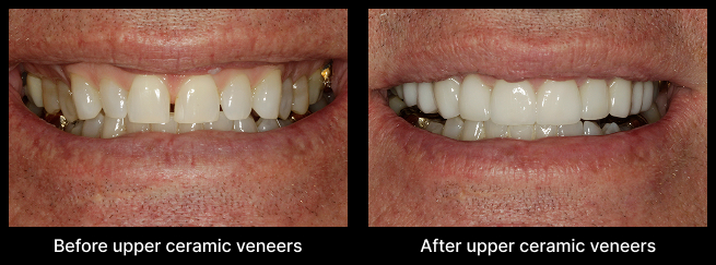 Dental Veneers Before After