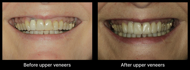 Dental Veneers Before After