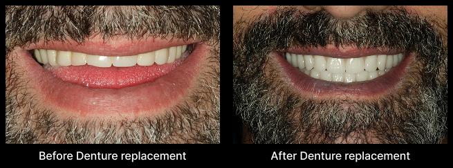 Denture Before After