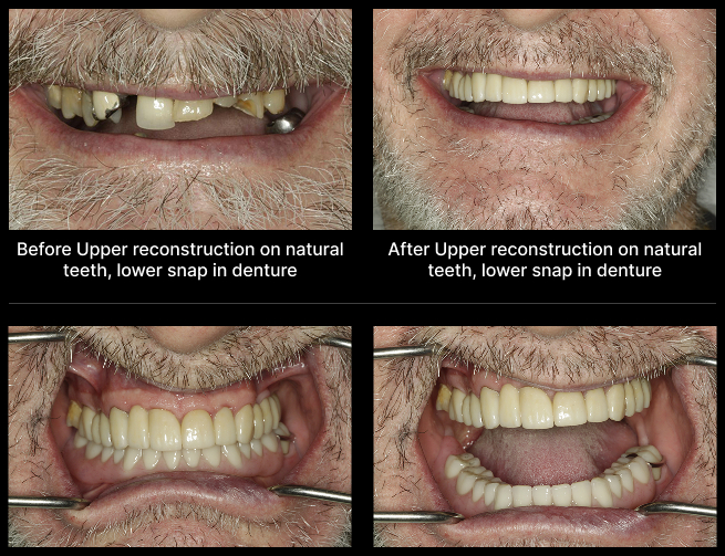 Denture Before After