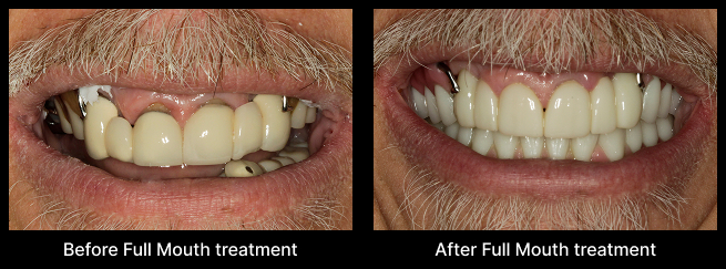 Full Mouth Treatment Before After