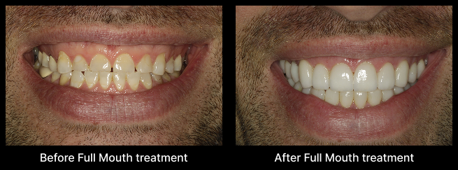 Full Mouth Treatment Before After