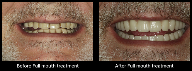Full Mouth Treatment Before After