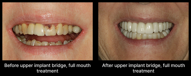 Full Mouth Treatment Before After