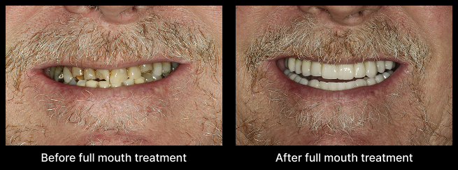 Full Mouth Treatment Before After