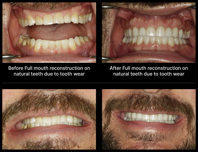 Full Mouth Treatment Before After